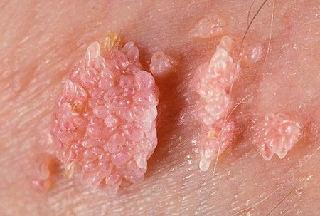 Condilomas Genitales