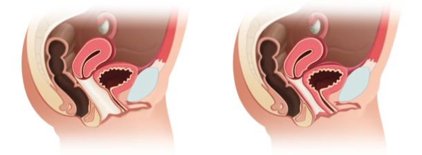 Síndrome de Relajación Vaginal